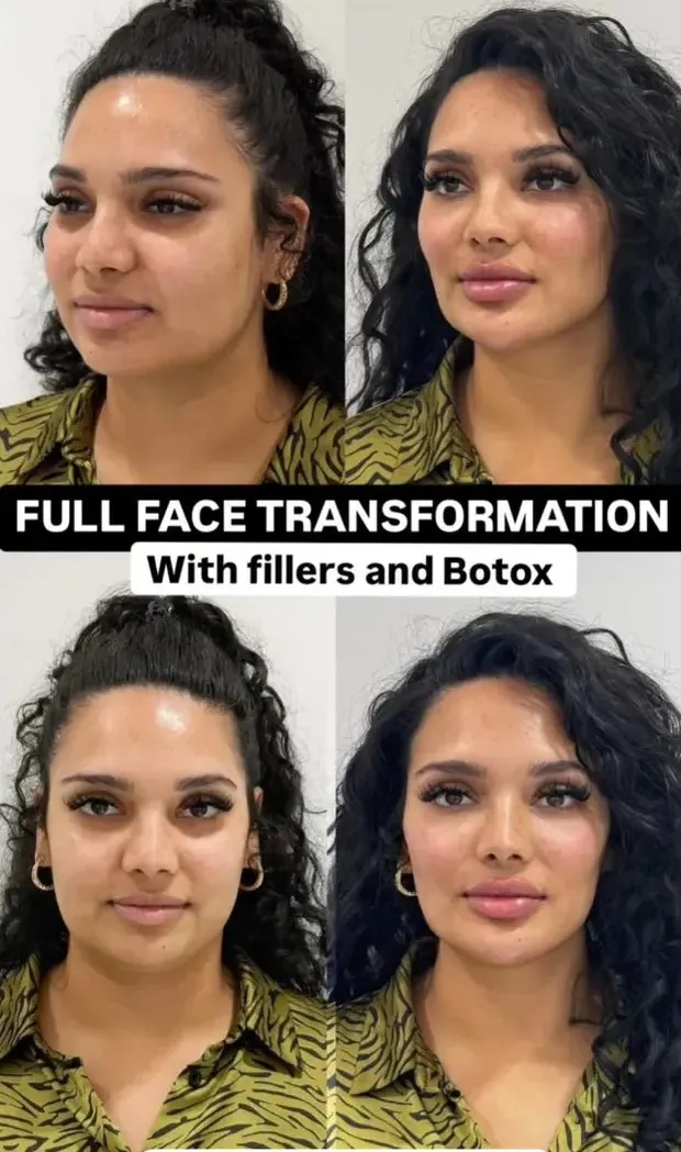 Full Face Transformation at Amoras Med Spa